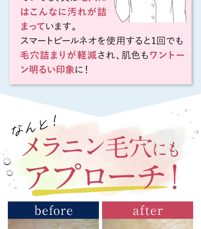 スマートピールネオがメラニン毛穴にもアプローチ!