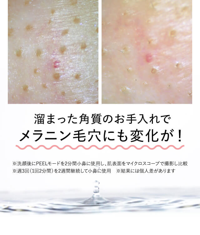 溜まった角質のお手入れでメラニン毛穴にも変化が!